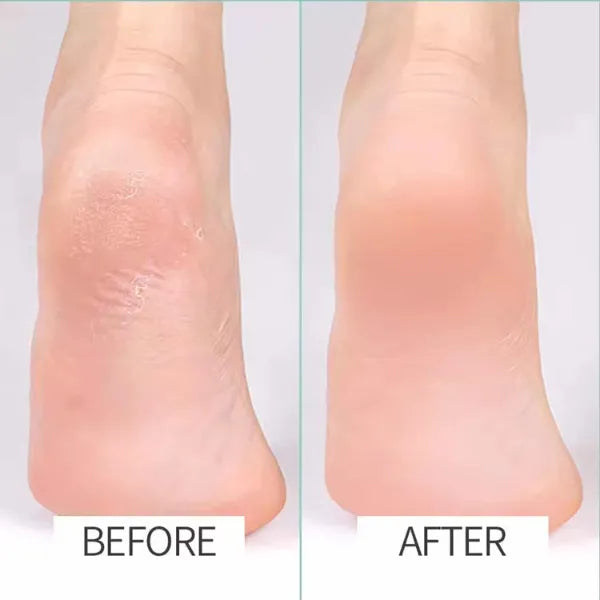 N2 ReCalus Foot Callus Remover US46